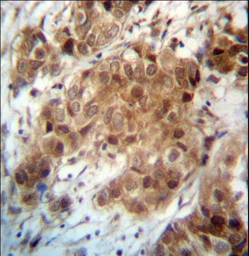 FOXO3 Antibody immunohistochemistry of formalin-fixed and paraffin-embedded human breast carcinoma followed by peroxidase-conjugated secondary antibody and DAB staining.