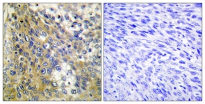 IHC of paraffin-embedded human cervix carcinoma tissue, using Collagen IV alpha6 Antibody. The picture on the right is treated with the synthesized peptide.