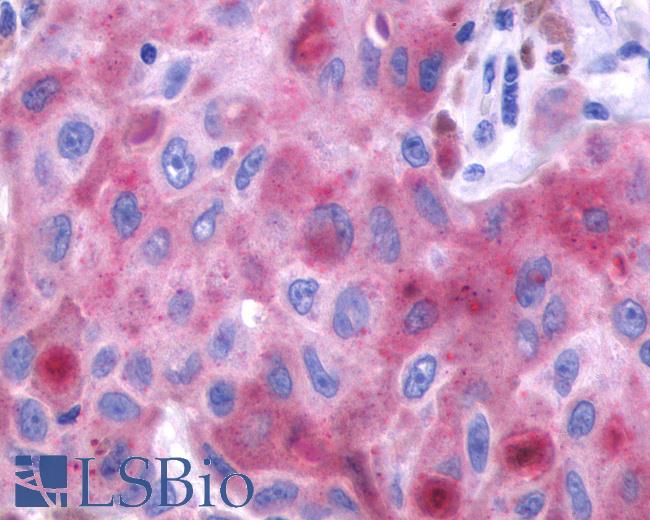 Anti-FP / PTGFR antibody IHC of human Skin, Melanoma. Immunohistochemistry of formalin-fixed, paraffin-embedded tissue after heat-induced antigen retrieval.