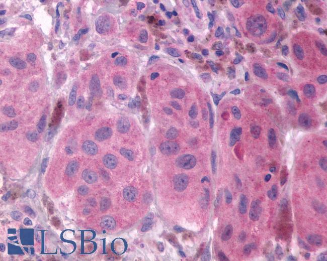 Anti-FP / PTGFR antibody IHC of human Skin, Melanoma. Immunohistochemistry of formalin-fixed, paraffin-embedded tissue after heat-induced antigen retrieval.