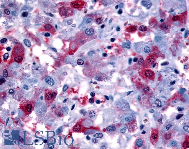 Anti-PTGFR antibody LS-A6625 IHC of human adrenal, pheochromocytes. Immunohistochemistry of formalin-fixed, paraffin-embedded tissue after heat-induced antigen retrieval.