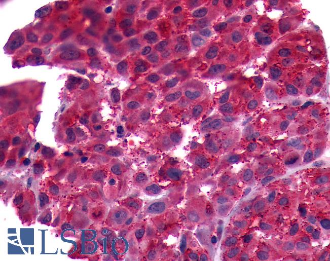 Anti-FP / PTGFR antibody IHC of human Skin, Melanoma. Immunohistochemistry of formalin-fixed, paraffin-embedded tissue after heat-induced antigen retrieval.