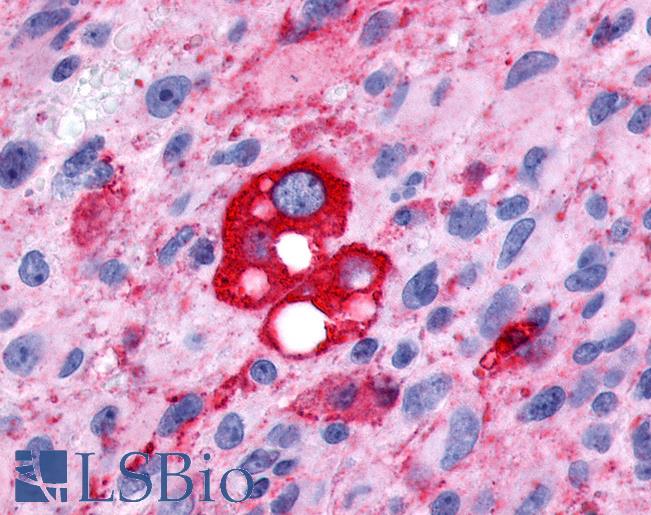 Anti-FP / PTGFR antibody IHC of human Brain, Glioblastoma. Immunohistochemistry of formalin-fixed, paraffin-embedded tissue after heat-induced antigen retrieval.