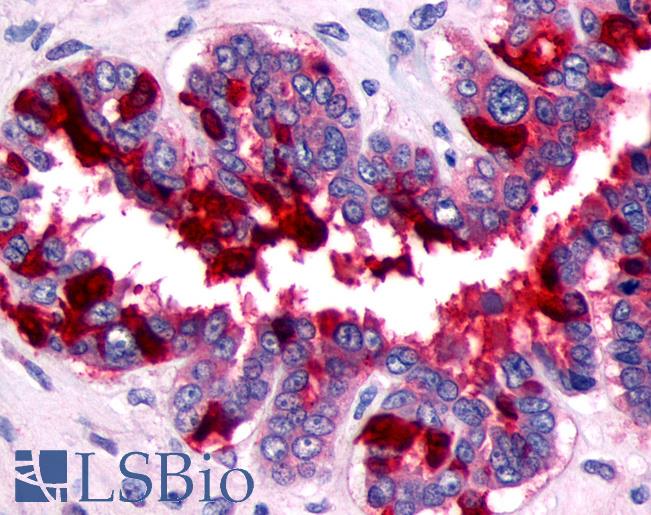 Anti-FP / PTGFR antibody IHC of human Ovary, Carcinoma. Immunohistochemistry of formalin-fixed, paraffin-embedded tissue after heat-induced antigen retrieval.