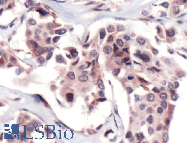 Immunohistochemistry of Human Breast Carcinoma stained with anti-FPGS antibody