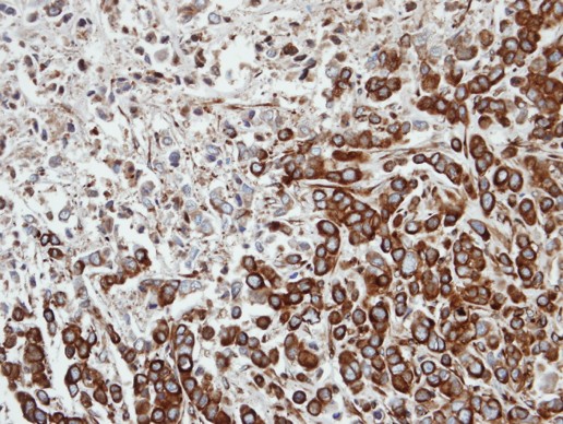 IHC of paraffin-embedded MDA-MB-468 xenograft using FPGT antibody at 1:100 dilution.