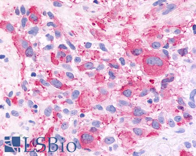 Anti-FSD2 / Frizzled 2 antibody IHC of human Brain, Glioblastoma. Immunohistochemistry of formalin-fixed, paraffin-embedded tissue after heat-induced antigen retrieval.