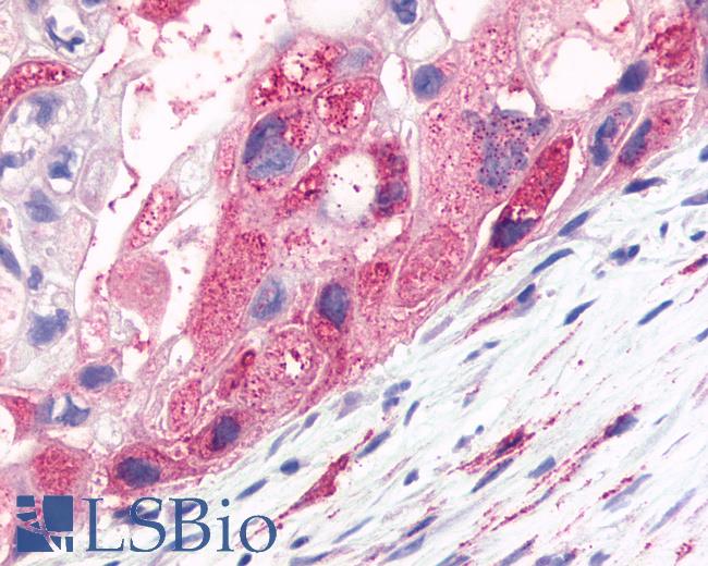 Anti-FSD2 / Frizzled 2 antibody IHC of human Pancreas, Carcinoma. Immunohistochemistry of formalin-fixed, paraffin-embedded tissue after heat-induced antigen retrieval.