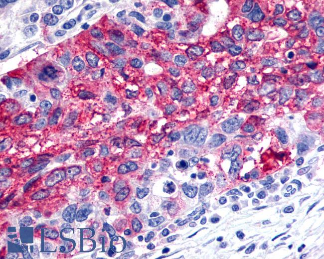Anti-FSD2 / Frizzled 2 antibody IHC of human Ovary, Carcinoma. Immunohistochemistry of formalin-fixed, paraffin-embedded tissue after heat-induced antigen retrieval.