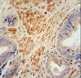 FSTL1 antibody immunohistochemistry of formalin-fixed and paraffin-embedded human prostate carcinoma followed by peroxidase-conjugated secondary antibody and DAB staining.