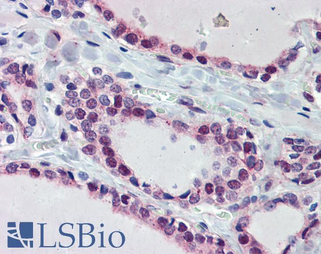 Anti-FUBP3 / FBP3 antibody IHC of human thyroid. Immunohistochemistry of formalin-fixed, paraffin-embedded tissue after heat-induced antigen retrieval. Antibody LS-B4018 concentration 5 ug/ml.