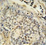 FUS antibody immunohistochemistry of formalin-fixed and paraffin-embedded human prostate carcinoma followed by peroxidase-conjugated secondary antibody and DAB staining.