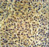 FUT6 Antibody IHC of formalin-fixed and paraffin-embedded bladder carcinoma followed by peroxidase-conjugated secondary antibody and DAB staining.