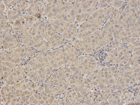 Immunohistochemistry of paraffin-embedded human liver cancer using FXN antibody at dilution of 1:100 (200x lens).