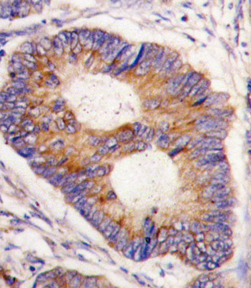 Formalin-fixed and paraffin-embedded human colon carcinoma tissue reacted with FXN antibody , which was peroxidase-conjugated to the secondary antibody, followed by DAB staining. This data demonstrates the use of this antibody for immunohistochemistry; clinical relevance has not been evaluated.