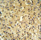 FYTD1 Antibody IHC of formalin-fixed and paraffin-embedded human cervix carcinoma followed by peroxidase-conjugated secondary antibody and DAB staining.