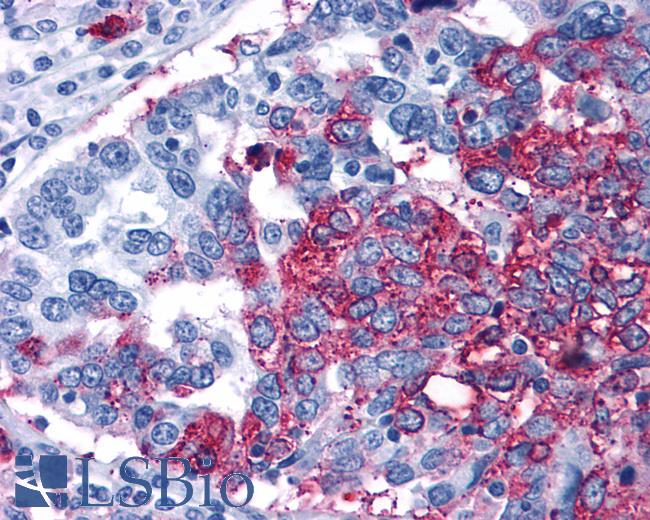 Anti-FZD1 / Frizzled 1 antibody IHC of human Ovary, Carcinoma. Immunohistochemistry of formalin-fixed, paraffin-embedded tissue after heat-induced antigen retrieval.
