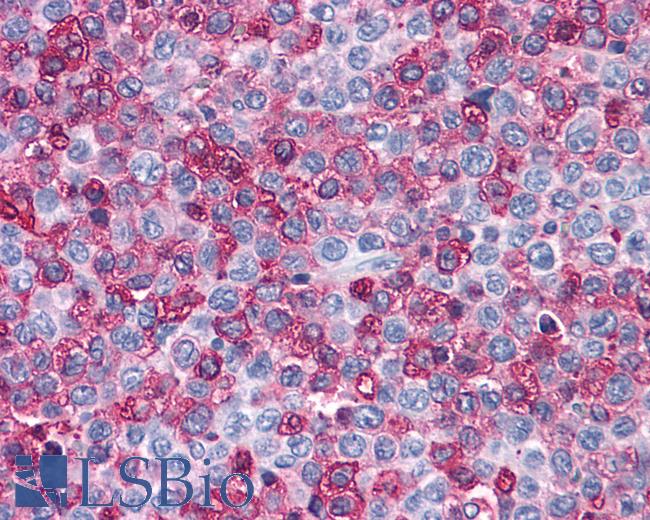 Anti-FZD1 / Frizzled 1 antibody IHC of human Lymph Node, Non-Hodgkins Lymphoma. Immunohistochemistry of formalin-fixed, paraffin-embedded tissue after heat-induced antigen retrieval.