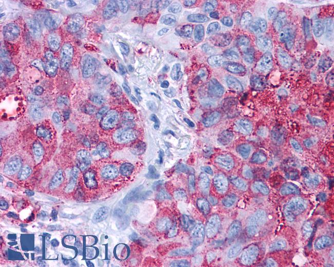 Anti-FZD1 / Frizzled 1 antibody IHC of human Lung, Non-Small Cell Carcinoma. Immunohistochemistry of formalin-fixed, paraffin-embedded tissue after heat-induced antigen retrieval.