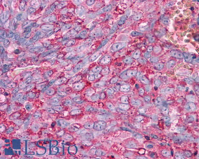 Anti-FZD1 / Frizzled 1 antibody IHC of human Ovary, Carcinoma. Immunohistochemistry of formalin-fixed, paraffin-embedded tissue after heat-induced antigen retrieval.