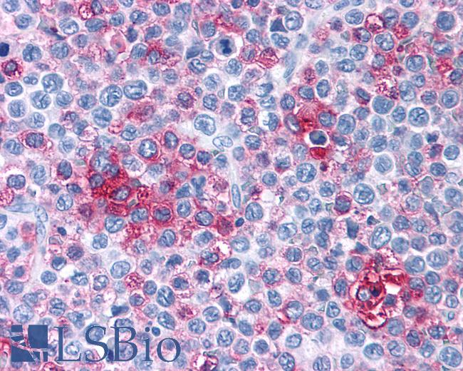 Anti-FZD1 / Frizzled 1 antibody IHC of human Lymph Node, Non-Hodgkins Lymphoma. Immunohistochemistry of formalin-fixed, paraffin-embedded tissue after heat-induced antigen retrieval.