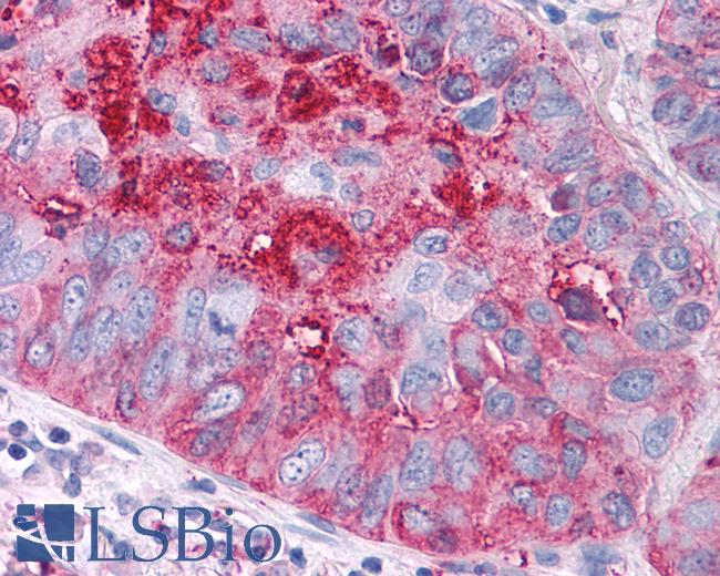 Anti-FZD1 / Frizzled 1 antibody IHC of human Lung, Non-Small Cell Carcinoma. Immunohistochemistry of formalin-fixed, paraffin-embedded tissue after heat-induced antigen retrieval.