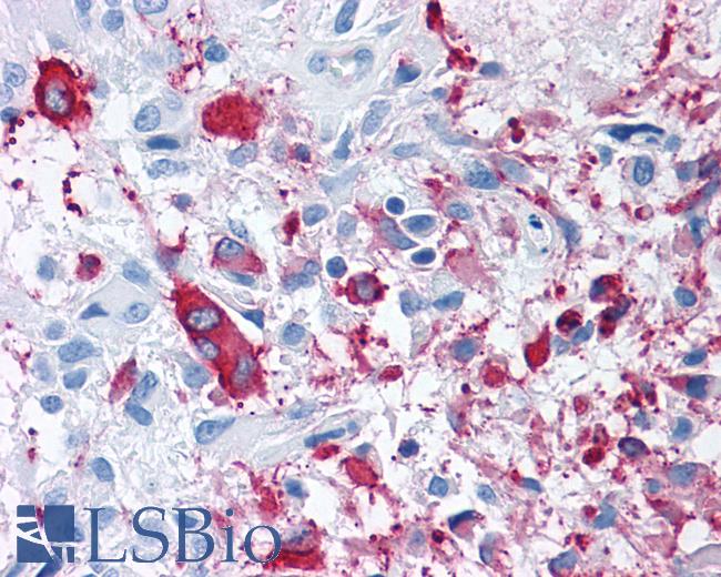 Anti-FZD3 / Frizzled 3 antibody IHC of human Brain, Glioblastoma. Immunohistochemistry of formalin-fixed, paraffin-embedded tissue after heat-induced antigen retrieval.