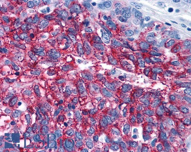 Anti-FZD3 / Frizzled 3 antibody IHC of human Ovary, Carcinoma. Immunohistochemistry of formalin-fixed, paraffin-embedded tissue after heat-induced antigen retrieval.