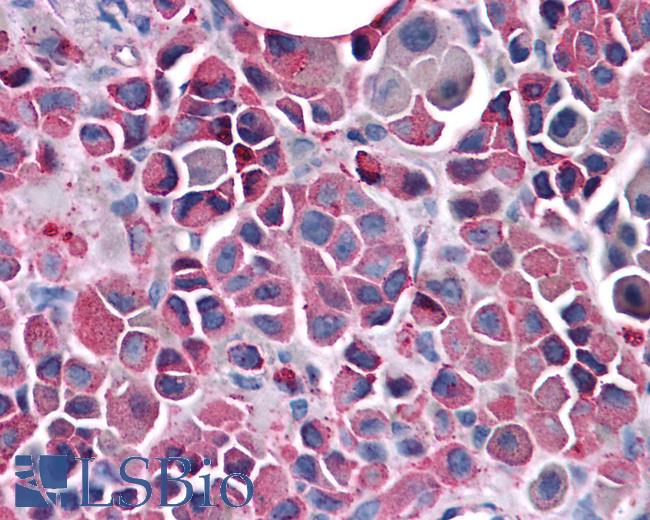 Anti-FZD3 / Frizzled 3 antibody IHC of human Skin, Melanoma. Immunohistochemistry of formalin-fixed, paraffin-embedded tissue after heat-induced antigen retrieval.
