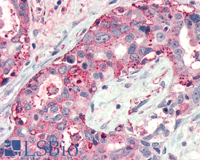 Anti-FZD4 / Frizzled 4 antibody IHC of human Pancreas, Carcinoma. Immunohistochemistry of formalin-fixed, paraffin-embedded tissue after heat-induced antigen retrieval.
