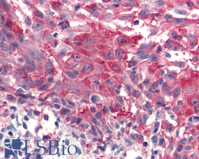 Anti-FZD4 / Frizzled 4 antibody IHC of human Skin, Melanoma. Immunohistochemistry of formalin-fixed, paraffin-embedded tissue after heat-induced antigen retrieval.