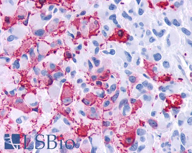 Anti-FZD4 / Frizzled 4 antibody IHC of human Brain, Glioblastoma. Immunohistochemistry of formalin-fixed, paraffin-embedded tissue after heat-induced antigen retrieval.