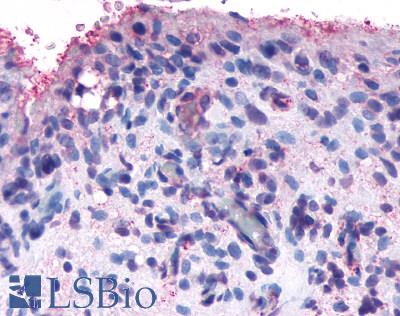 Anti-FZD5 / Frizzled 5 antibody LS-A4284 IHC of human synovium, rheumatoid arthritis. Immunohistochemistry of formalin-fixed, paraffin-embedded tissue after heat-induced antigen retrieval.