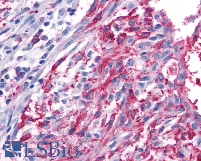 Anti-FZD5 / Frizzled 5 antibody IHC of human Skin, Melanoma. Immunohistochemistry of formalin-fixed, paraffin-embedded tissue after heat-induced antigen retrieval.