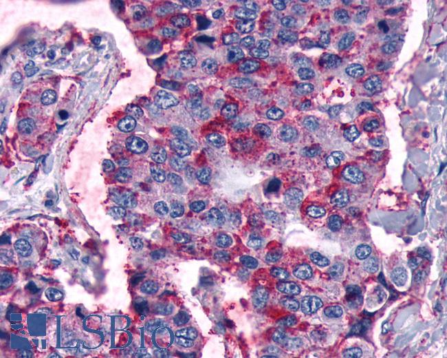 Anti-FZD5 / Frizzled 5 antibody IHC of human Lung, Non-Small Cell Carcinoma. Immunohistochemistry of formalin-fixed, paraffin-embedded tissue after heat-induced antigen retrieval.