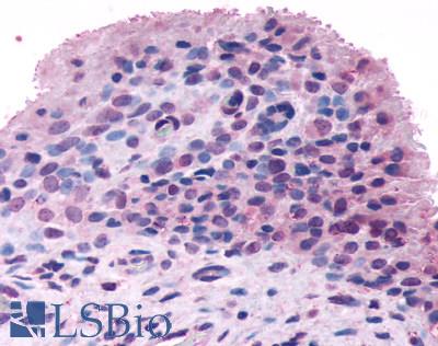 Anti-FZD5 / Frizzled 5 antibody LS-A4273 IHC of human synovium, rheumatoid arthritis. Immunohistochemistry of formalin-fixed, paraffin-embedded tissue after heat-induced antigen retrieval.