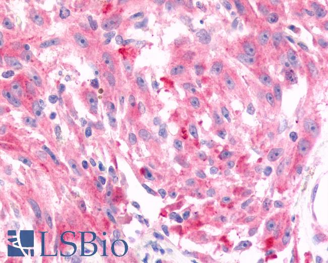 Anti-FZD6 / Frizzled 6 antibody IHC of human Skin, Melanoma. Immunohistochemistry of formalin-fixed, paraffin-embedded tissue after heat-induced antigen retrieval.