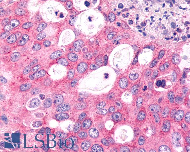 Anti-FZD6 / Frizzled 6 antibody IHC of human Lung, Non-Small Cell Carcinoma. Immunohistochemistry of formalin-fixed, paraffin-embedded tissue after heat-induced antigen retrieval.