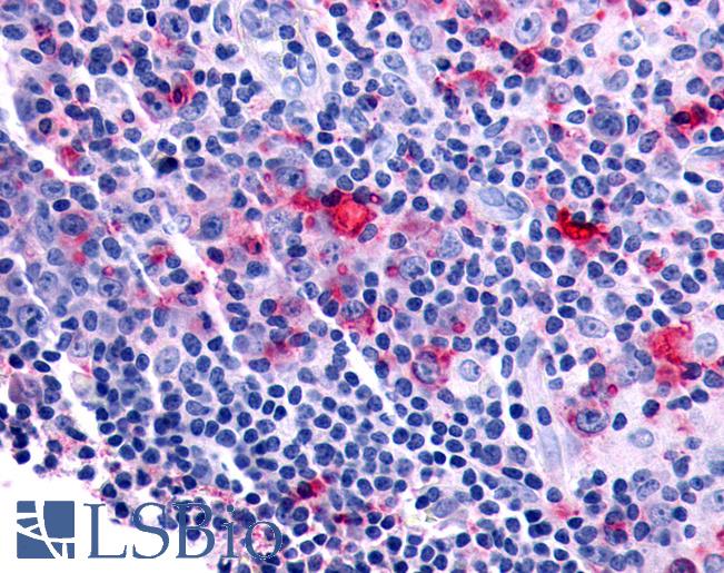 Anti-FZD8 / Frizzled 8 antibody IHC of human Lymph Node, Hodgkins Lymphoma. Immunohistochemistry of formalin-fixed, paraffin-embedded tissue after heat-induced antigen retrieval.