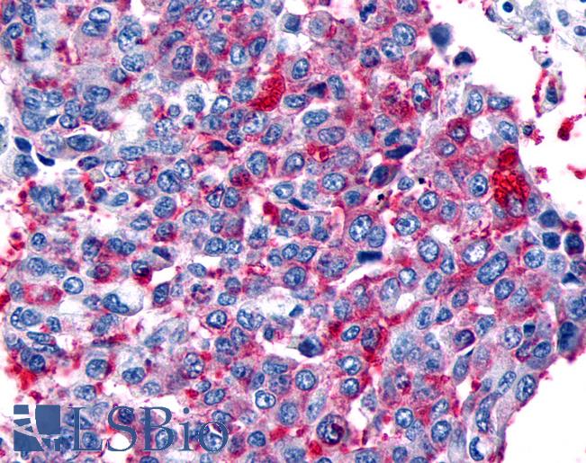 Anti-FZD8 / Frizzled 8 antibody IHC of human Lung, Non-Small Cell Carcinoma. Immunohistochemistry of formalin-fixed, paraffin-embedded tissue after heat-induced antigen retrieval.