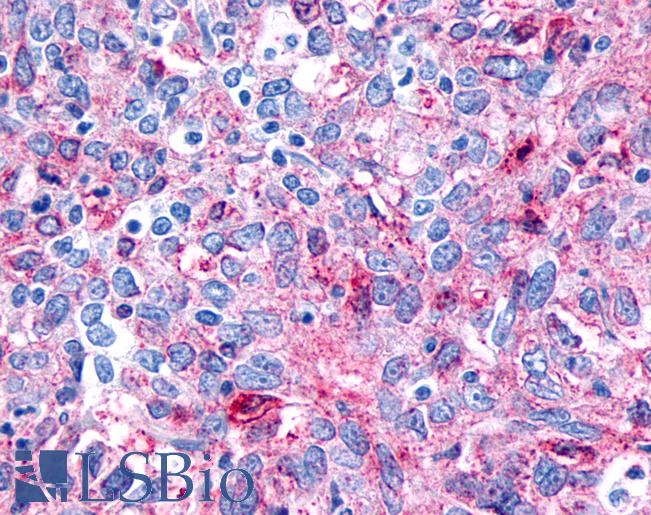 Anti-FZD8 / Frizzled 8 antibody IHC of human Ovary, Carcinoma. Immunohistochemistry of formalin-fixed, paraffin-embedded tissue after heat-induced antigen retrieval.
