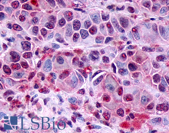Anti-FZD8 / Frizzled 8 antibody IHC of human Skin, Melanoma. Immunohistochemistry of formalin-fixed, paraffin-embedded tissue after heat-induced antigen retrieval.