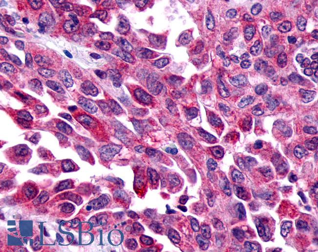 Anti-FZD8 / Frizzled 8 antibody IHC of human Lung, Non-Small Cell Carcinoma. Immunohistochemistry of formalin-fixed, paraffin-embedded tissue after heat-induced antigen retrieval.