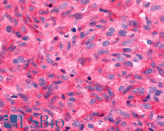 Anti-FZD9 / Frizzled 9 antibody IHC of human Brain, Glioblastoma. Immunohistochemistry of formalin-fixed, paraffin-embedded tissue after heat-induced antigen retrieval.