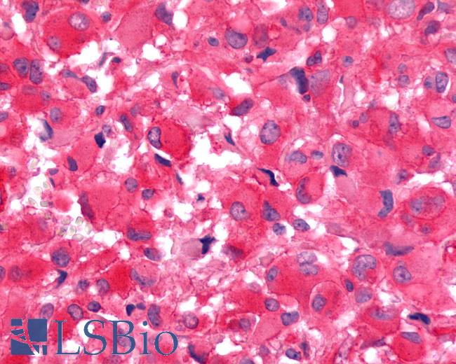 Anti-FZD9 / Frizzled 9 antibody IHC of human Brain, Glioblastoma. Immunohistochemistry of formalin-fixed, paraffin-embedded tissue after heat-induced antigen retrieval.