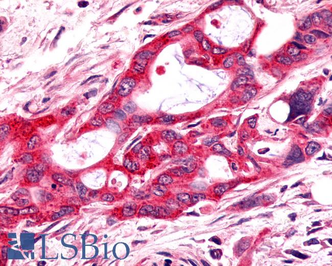 Anti-FZD9 / Frizzled 9 antibody IHC of human Pancreas, Carcinoma. Immunohistochemistry of formalin-fixed, paraffin-embedded tissue after heat-induced antigen retrieval.