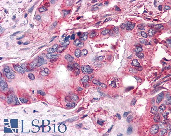 Anti-FZD9 / Frizzled 9 antibody IHC of human Pancreas, Carcinoma. Immunohistochemistry of formalin-fixed, paraffin-embedded tissue after heat-induced antigen retrieval.