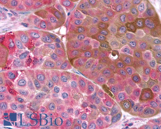 Anti-FZD9 / Frizzled 9 antibody IHC of human Skin, Melanoma. Immunohistochemistry of formalin-fixed, paraffin-embedded tissue after heat-induced antigen retrieval.