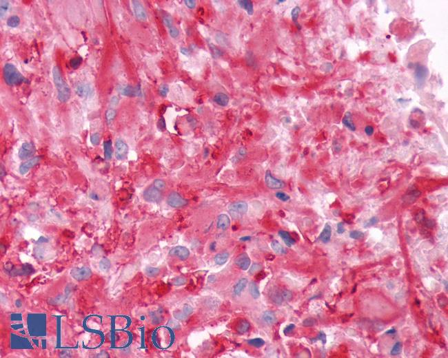 Anti-FZD9 / Frizzled 9 antibody IHC of human Brain, Glioblastoma. Immunohistochemistry of formalin-fixed, paraffin-embedded tissue after heat-induced antigen retrieval.