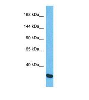 Western blot of Human Esophagus Tumor. CHSY2 antibody dilution 1.0 ug/ml.